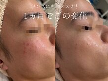 ラシュール(Rassure)/メンズのニキビケアにも