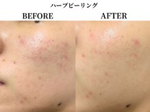 サンビ(SANBI)/肌質改善でトーンアップ！