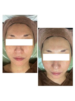 カヌヌ(Kanunu)/プラズマシャワーと小顔リフト