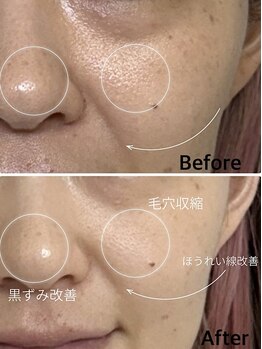 シャムリー(SHAMRY)/TROIAREUKE／スキンメイド毛穴