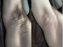 リエラ(Liella)/【ワキ脱毛】