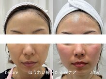 マイ フェア レディ(MY FAIR LADY)の雰囲気（"毛穴侍+松ヤニパックの実力"ほうれい線・たるみケア）