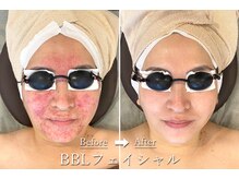 ギンレイ(GINREI)の雰囲気（美肌効果実感★お肌全体がトーンアップ毛穴軽減BBLフェイシャル）