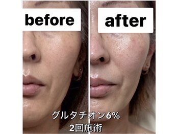 ナチュラ ソース(NatureSouce)/ホワイトニング、美白