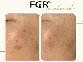 ワイキューマルサン(y903)/【FCRハーブピーリング】