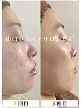 ビーエックス(.BX)/ハーブピーリング Before/After