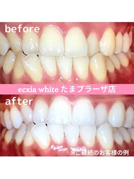 エクシアホワイトニング たまプラーザ店/ビフォーアフター
