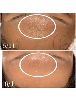 楚々(SOSO)/before afterおでこ