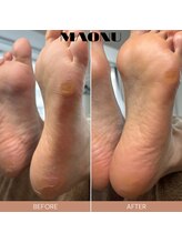 マオヌー(MAONU)/韓国式足裏角質ケア