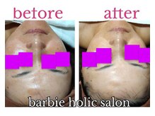 バービーホリック(barbie holic)/フェイシャルコース　施術前後