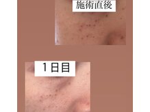 ジュエル(jewel)の雰囲気（低周波で痛みやダウンタイムがなく、施術後すぐにメイクも可能。）