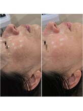 イチグラム(Ichi Glam)/美白トリートメント効果