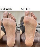 クオッカ(Quokka)/角質ケア