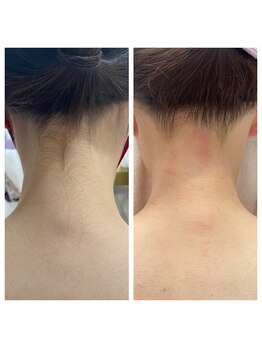 ラフィーネ(Raffine)/後ろ姿美人☆襟足うなじ脱毛