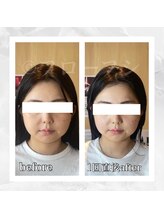 フローフシ∞/【小顔】20代女性症例写真