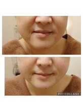 サロンドエステ ルヴニール(salon de esthe revenir)/一度の施術ビフォーアフター