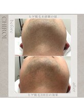 チロル(CHIROL)/ヒゲ脱毛3回目の効果