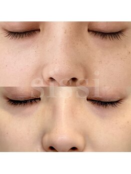 シシィ 二子玉川(sissi)/シミ改善 画像タップで拡大