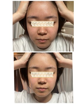 ブリリアント(Brilliant)/ニキビケア!ピーリング