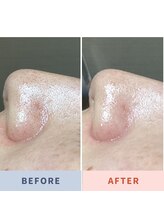 ソリス ビューティー(SOLIS BEAUTY)/毛穴洗浄