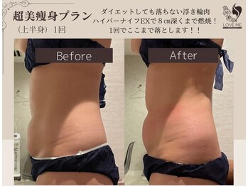 ラブミー 渋谷本店(LoveMe)/骨盤矯正/ハイパーナイフEX/痩身