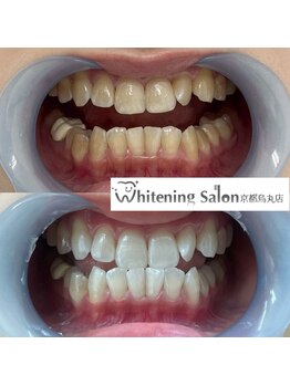 ホワイトニングサロン 京都烏丸店/ホワイトニング施術例