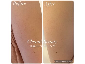 クリーンアンドビューティ 札幌(Clean&Beauty)/二の腕の毛孔性苔癬にも◎