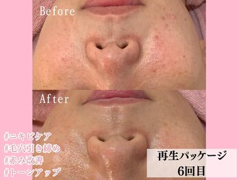 エンクリニカルラボ 三宮店(E&N CLINICAL LABO)/ハーブピーリング白玉パッケージ