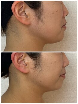 ルミア(LUMIA)/30代／輪郭のもたつきがお悩み