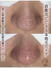 エメ(Aimer)/毛穴専門店の毛穴ケア