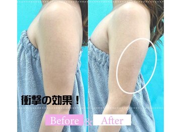 小顔専門カンナムビューティー 麻布十番店【ララピール/ハーブピーリング/小顔/痩身】/オンダリフト/麻布十番/六本木