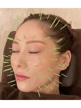 しんたろう鍼灸整骨院の写真/頑張る自分へのご褒美に。メディセルハイブリッドと美容鍼で叶える贅沢フェイスケア