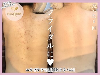 ハーバリー ハーブピーリング 金山店(HERBERRYハーブピーリング)/ハーブピーリング専門店HERBERRY