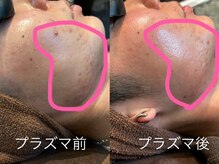 リ シャルム(Re Charme)/フェイシャルメニュー施術後☆