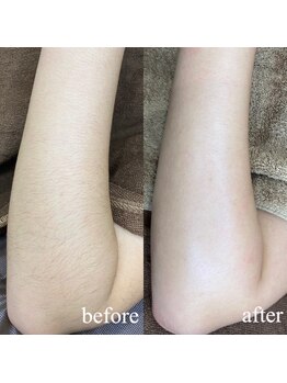 ユウユウ(YUYU)/艶の極み脱毛:Mパーツ