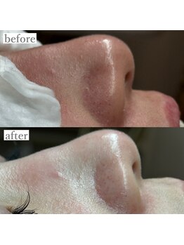 ライカブルー(RaicA BluE)/施術写真　before-after