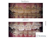 エヌエーホワイトニング たまプラーザ店(NA whitening)の雰囲気（矯正中の歯もホワイトニング可能！セルフだから自分ペースで♪）