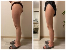 ディーメヴィ(D.MAVIE)/筋膜リリースで前もも撃退