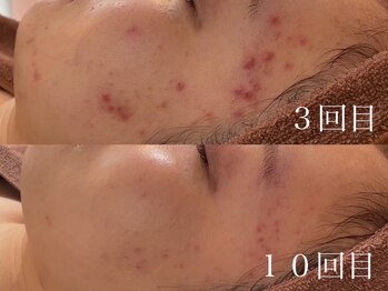 ホワイトアクア 京都店(WHITE AQUA)/ハーブピーリング/毛穴/京都