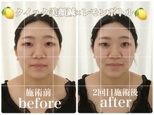 アキュモンド 渋谷院(acumond)/輪郭改善◆レモンボトル×美容鍼