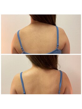 ミチカケ トリムリターン那覇市店/美しい肩のラインに！