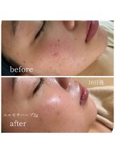 スパ 香炉/ピーリング