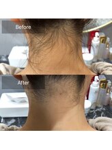 ナチュラル シャイン(NATURAL SHINE)/うなじ脱毛