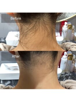 ナチュラル シャイン(NATURAL SHINE)/うなじ脱毛