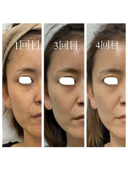 シスタス(Cistus)/【ExoLift】ビフォーアフター