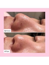 ホワイトラボ 天王寺(White labo)/【施術例】ハイドロフェイシャル