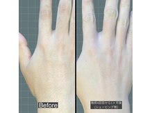 アレッド 大阪店(ared.)/手の甲脱毛