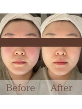 凪眠/小顔リンパフェイシャルの効果62