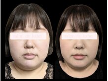 サロン ド 花歩 松山本店/お顔がひと回り小さくなりました