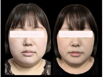 サロン ド 花歩 松山本店/お顔がひと回り小さくなりました